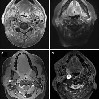 Axial Mr Images Of The Four Cases A Tongue Base Recurrence From