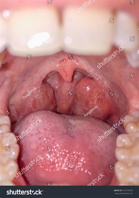 Tonsils Swollen Due Inflammation Patient