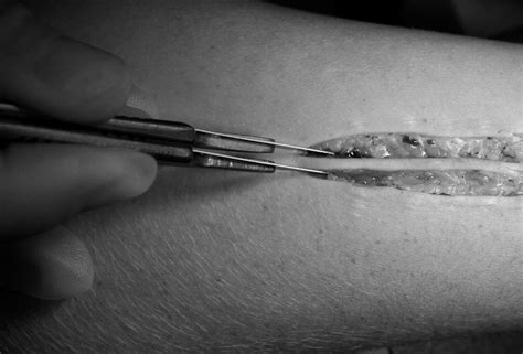 Two Knife Scar Excision The Annals Of The Royal College Of Surgeons Of England