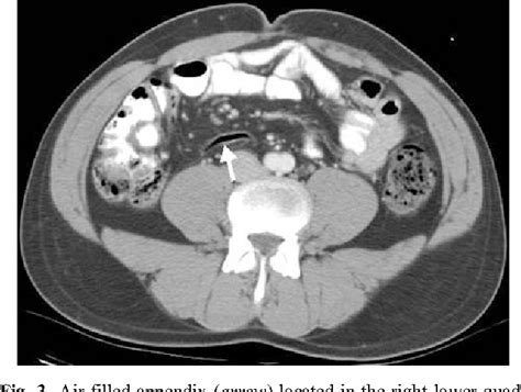 Ct Appearance Of The Normal Appendix In Adults Semantic Scholar