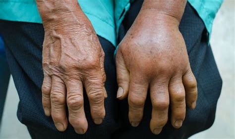 Lung Cancer Symptoms Three Major Clues In A Persons Hands That Could