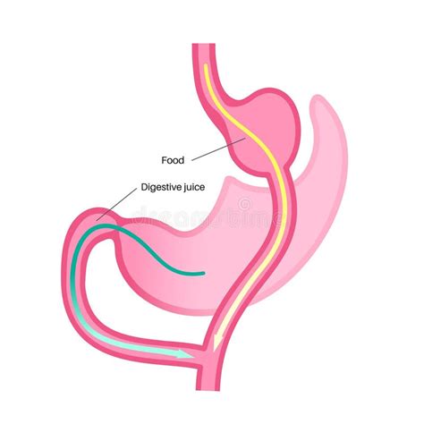 Gastric Operation Stock Illustrations 447 Gastric Operation Stock
