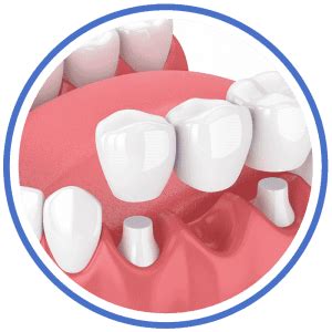 Fixed Prosthetics | Oxley Dental of Vidalia