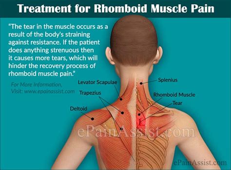 Rhomboid Muscle Paincausessymptomstreatmentexercisesprevention