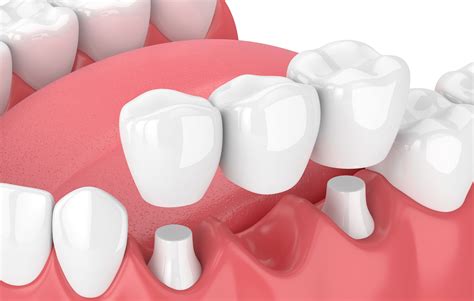 Dental Bridges Aurora Restorative Dentistry Pontic Teeth