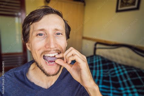 Man Placing A Bite Plate In His Mouth To Protect His Teeth At Night
