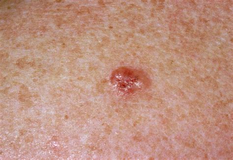 These melanoma pictures can help you determine what to look for. Skin Cancer Warning Signs - What Skin Cancer Looks Like