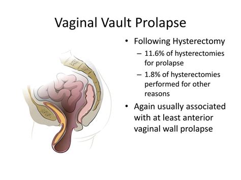 Vaginal Vault Prolapse Stock Image M Science Hot Sex Picture
