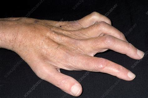 Ulnar Nerve Claw Hand
