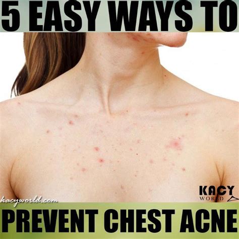 How To Get Rid Of Chest Acne Quickly Chest Acne Acne
