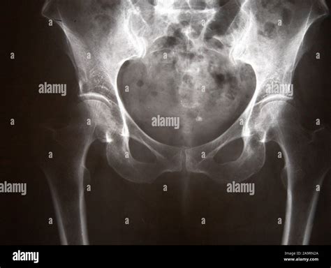 Pelvic Anatomy Xray Interpreting X Rays Of The Pelvis Hip Joint And
