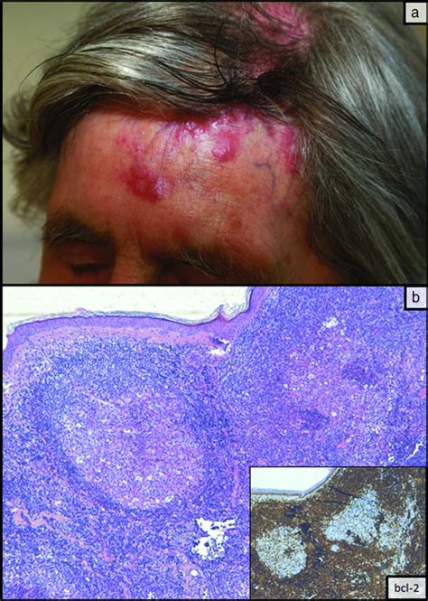 Cancerous Scalp Lesions