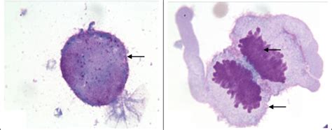 Csf Cytology Wrights Staining × 400 Showing Malignant Cells 21