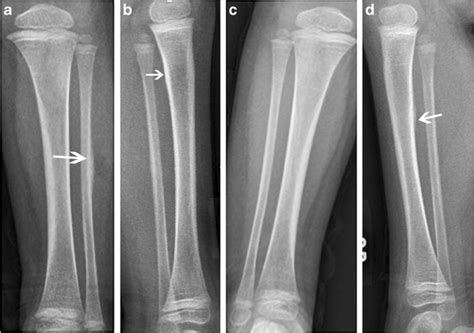 Ap And Lateral Radiographs Of The Left Tibia And Fibula A B And Ap