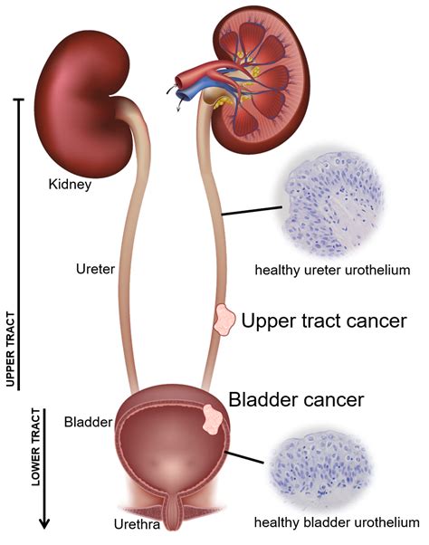 Beyond The Bladder Understanding Rare Cancers Of The Upper Urinary