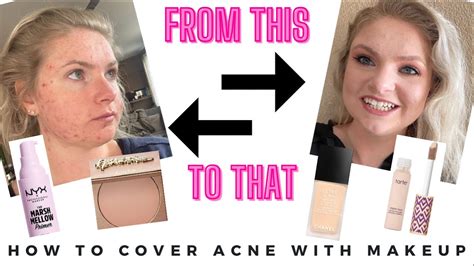 How To Cover Acne With Makeup While On Accutane Youtube