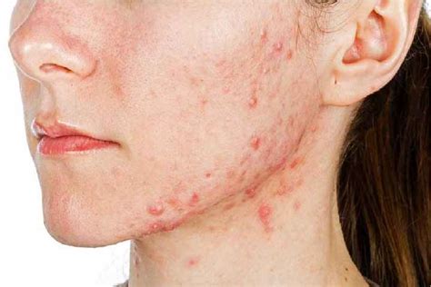 How To Maintain Acne Prone Skin Girlicious Beauty