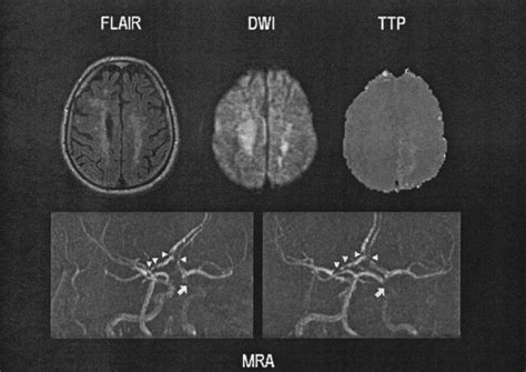 Assessment Of Transient Ischemic Attack With Diffusion And Perfusion