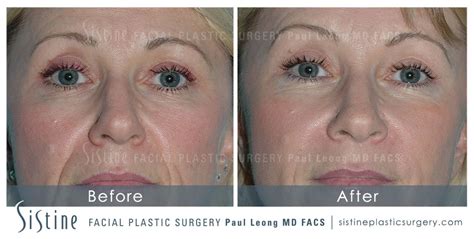Nasolabial Folds Before And After 02 Sistine Facial Plastic Surgery