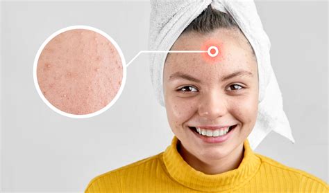 Understanding Acne Types Causes And Treatment Solutions