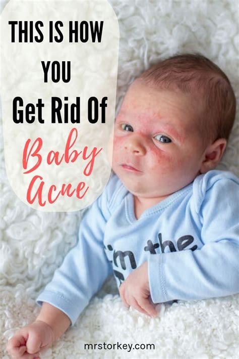 Why Do Babies Get Acne Read On These Comprehensive Tips On How To Get