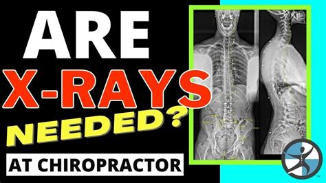 Xrays Taken At Chiropractor Are They Really Necessary Youtube