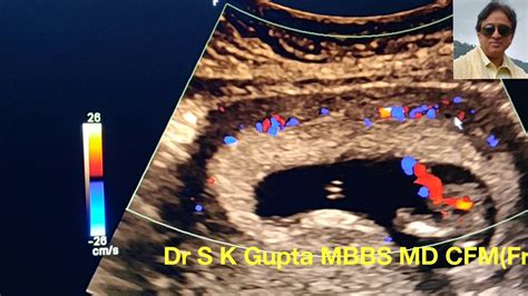 Bleeding In Pregnancy Subchorionic Bleedretroplacental Hematoma