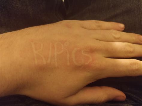 I Have A Skin Condition Known As Dermatographic Urticaria Aka Skin