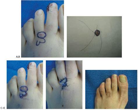 Local And Distant Pedicle Flaps For Soft Tissue Reconstruction Of The