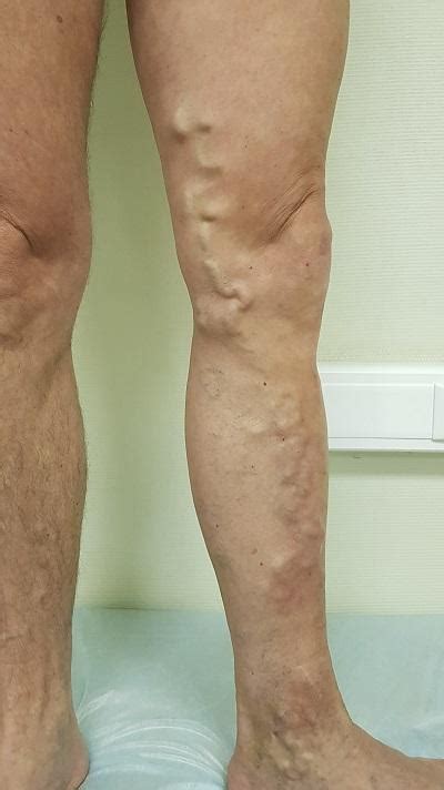 A superficial vein, it is formed in the dorsum of the foot and courses along the along the entire length of the lower limb and terminates in the femoral vein. Varicose disease of the lower extremities - causes ...