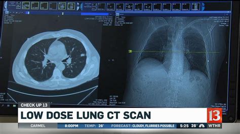 Check Up Low Dose Lung Ct Scan Wthr