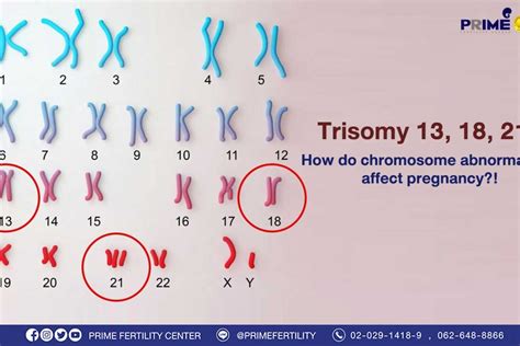 Trisomy 13 18 21 How Do Chromosome Abnormalities Affect Pregnancy