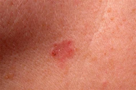Start Of Skin Cancer On Face