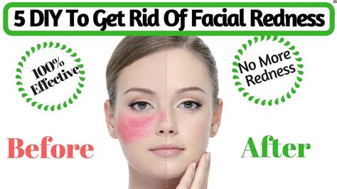 natural tips to get rid of facial redness how to cure red irritated skin avni youtube