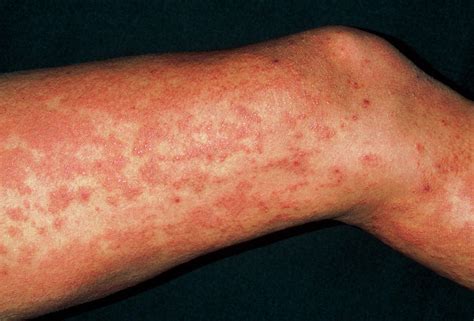 Urticaria Rash Hives On Legs Due To Exam Stress Photograph By Dr P Marazzi Science Photo Library