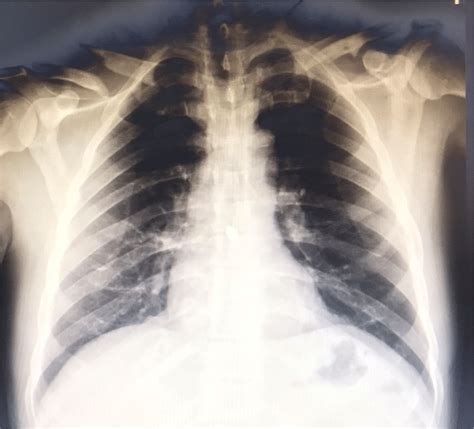 Chest X‐ray Pa View Showing Bilateral Clavicular Fracture Download