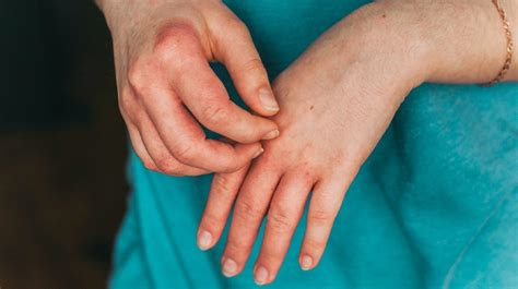 Dyshidrotic Eczema Itch In Hand And Feet