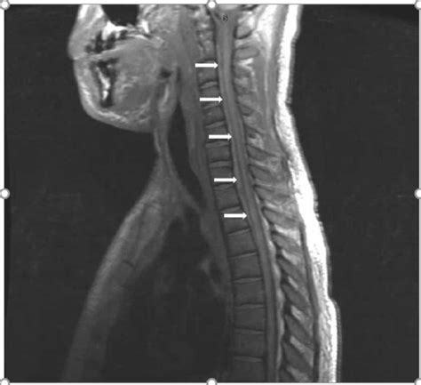 MRI Cervical And Thoracic Spine Sagittal Subtle Intermediate T Signal Download Scientific