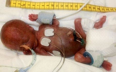 Decimal to fraction results for: Tiny Baby Survives After Arriving Weighing Just 9 Ounces
