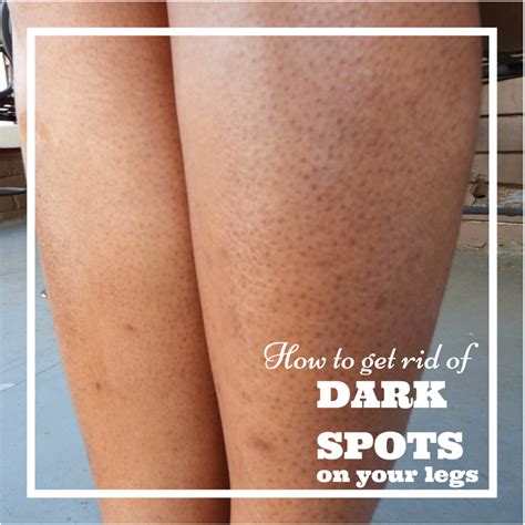 Pin By Charmain Persent On Healthy Living Dark Spots On Legs Spots