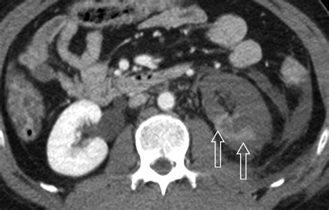 Kidney In Danger Ct Findings Of Blunt And Penetrating Renal Trauma