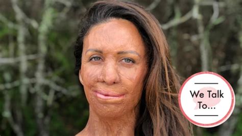 Turia Pitt ‘i Lost Friends After The Fire And It Hurt’ Body Soul