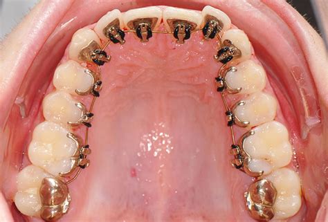 Lingual Braces Available Treatments Riverhouse Orthodontic Practice