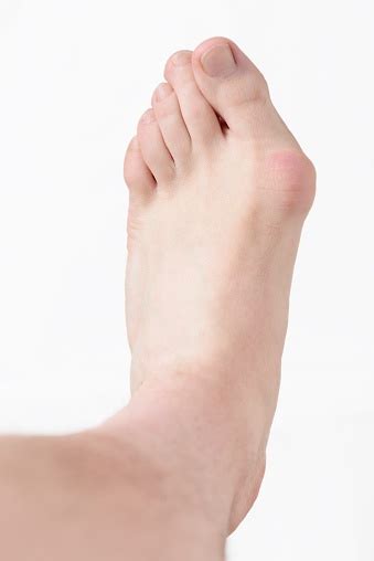 Basics Of Bunion Pain Causes Symptoms And Treatment Nagy Footcare