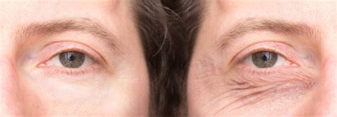 Best Treatments And Remedies For Early Eye Wrinkles Skincarederm
