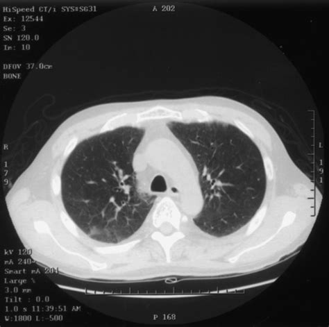 Ct Scans Of The Chest Appeared Almost Normal With A Small Area Of