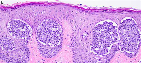 Pathology Outlines Special Site Nevus