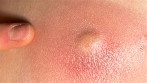 This usually leads just to a standard ingrown hair. Cyst vs. boil: Identification, symptoms, causes, and ...