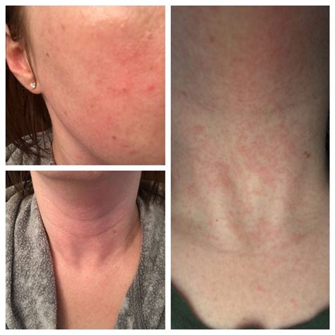 Skin Concerns Itchy Hive Y Rash On Mostly Neck Some