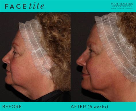 Double Chin Treatment 5 Options For A Contoured Chin Knoxville Tn